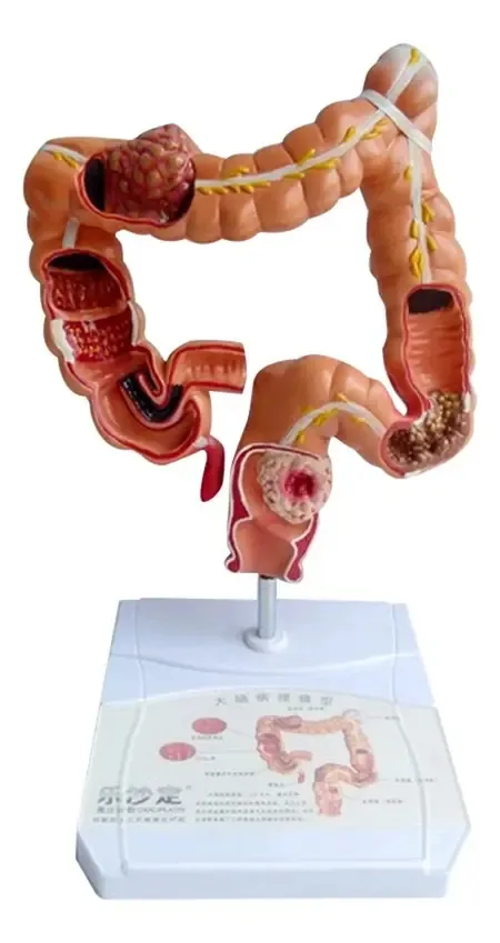 Modelo Anatômico Sistema Digestivo Intestino Lesão Visceral