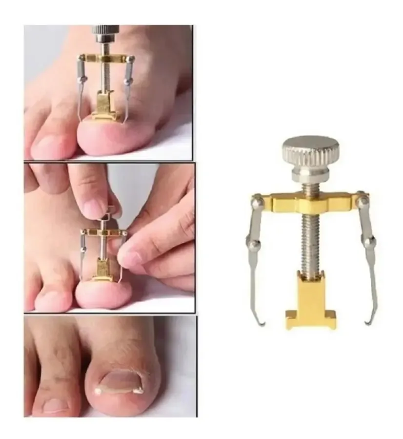 Clipe de elevação de unhas encravadas