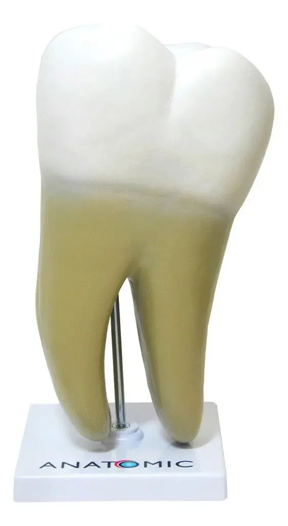 Dente Molar Ampliado Saudável E Cárie
