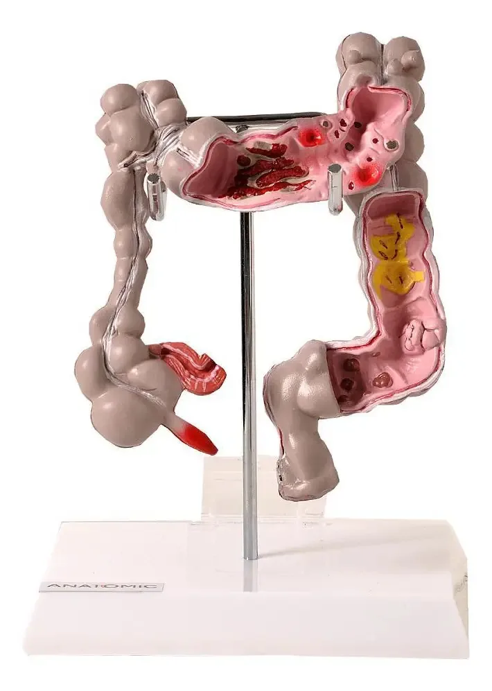 Intestino Grosso Humano Com Patologia, Anatomia