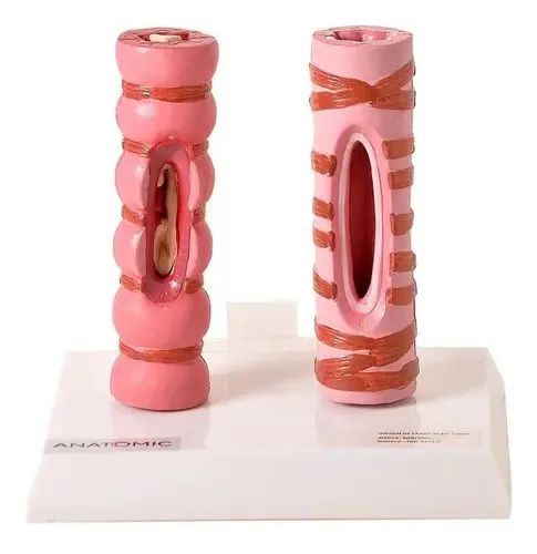 Brônquio Saudável e Patológico Anatomic Tgd-0314-p