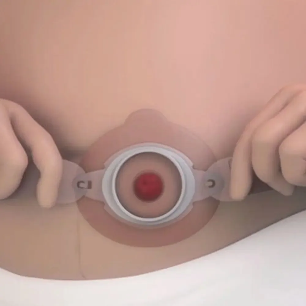 Cinto Elástico P/ Bolsa De Colostomia Tam P Casex
