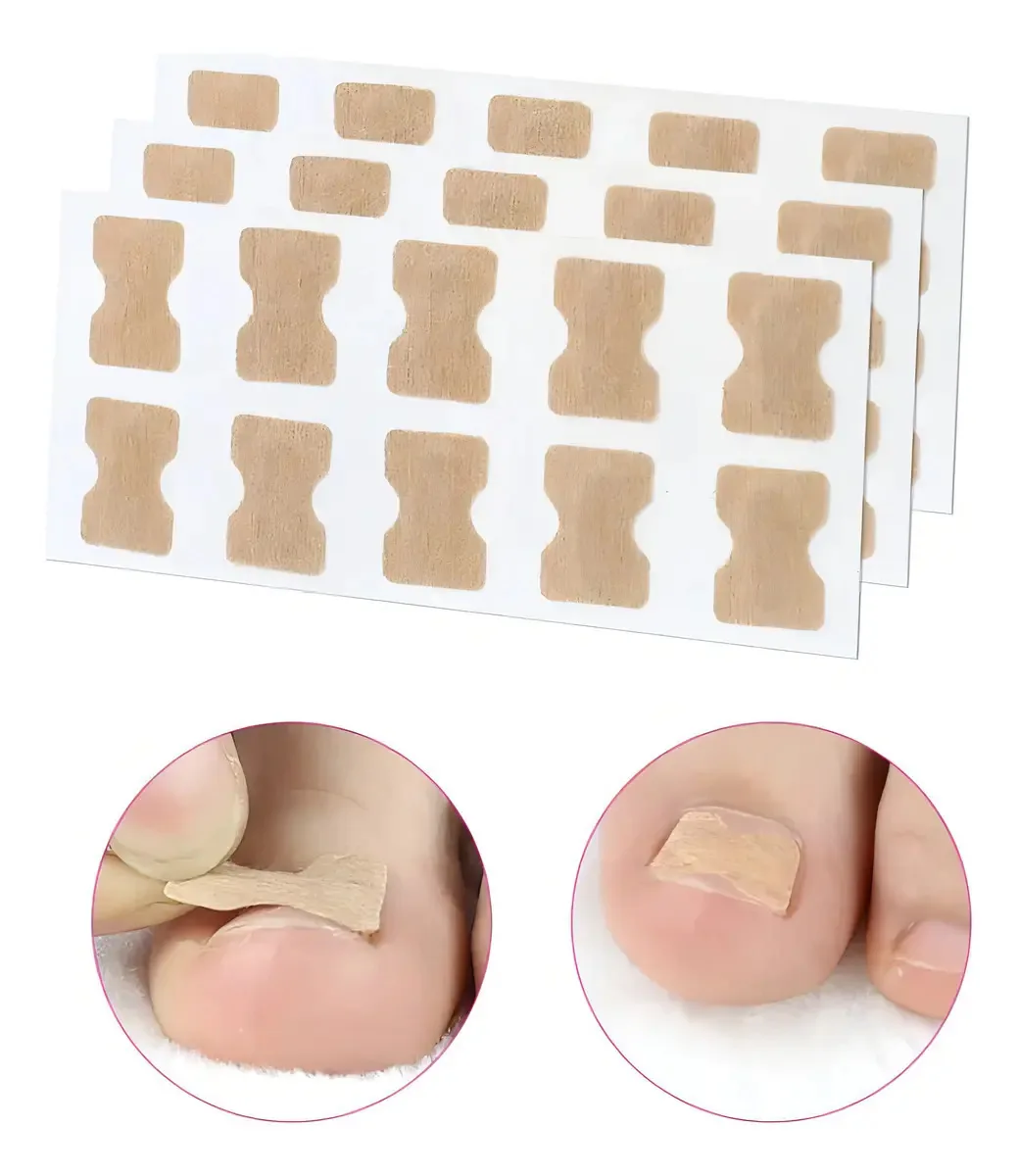Kit 30 Adesivos Ortese Desencravador de Unhas Delab Impermeável